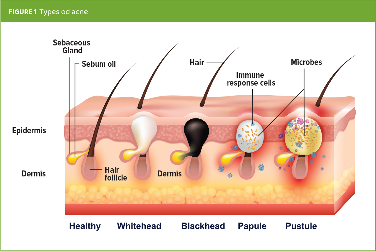 Black Seed Oil Role in Acne Mechanisms and Occurrence - B2B Nutramedic ...